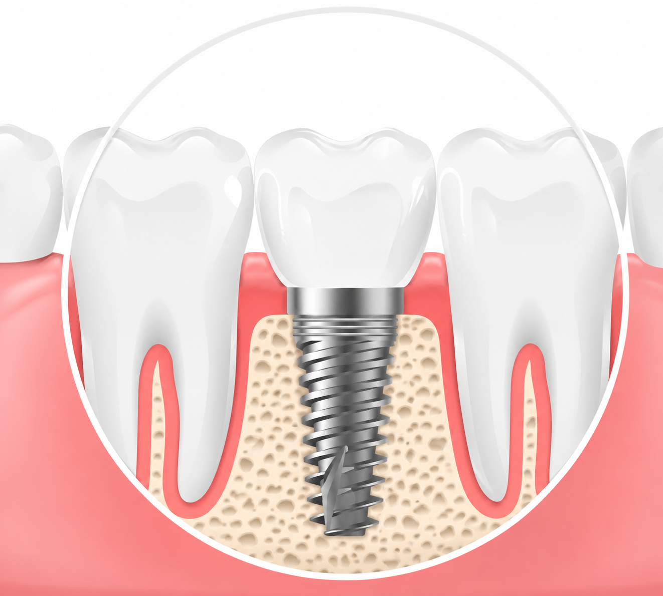 Implante dentário cerâmico de zircônia, livre de metal