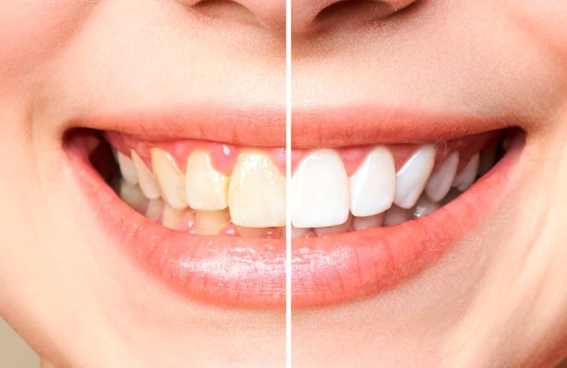 Facetas de cerâmica e lentes de contato dental para design de sorriso